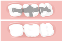 Composite, tooth colored fillings, dentist, cosmetics, implants, orthodontics, lawrenceville, Georgia, 30043