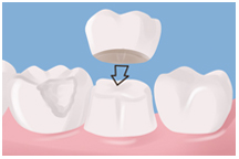 Dental crown, bridges, dentist, cosmetics, implants, orthodontics, lawrenceville, Georgia, 30043