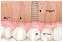 Dental implant, dentist, cosmetics, implants, orthodontics, lawrenceville, Georgia, 30043