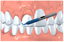 Gum surgery, gingivectomy, dentist, cosmetics, implants, orthodontics, lawrenceville, Georgia, 30043