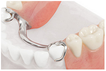 Denture, partial, implant, dentist, cosmetics, implants, orthodontics, lawrenceville, Georgia, 30043