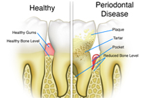 Periodontal, gum, disease, deep cleaning, dentist, cosmetics, implants, orthodontics, lawrenceville, Georgia, 30043