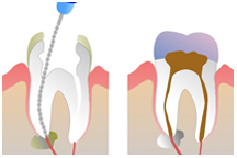 Root canal treatment, endodontics, dentist, cosmetics, implants, orthodontics, lawrenceville, Georgia, 30043