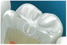 Dental sealants, flouride treatment, dentist, cosmetics, implants, orthodontics, lawrenceville, Georgia, 30043
