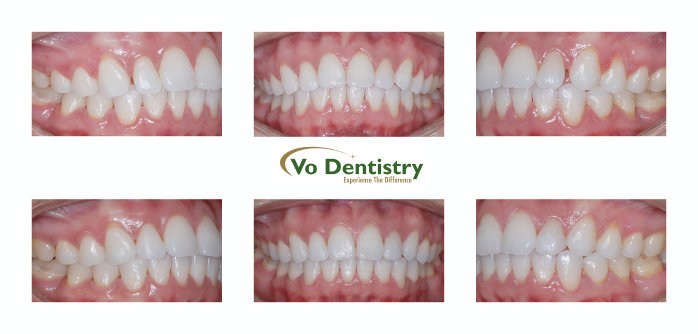 Peg lateral incisors, small lateral incisors, tooth colored restorations, lawrenceville, GA Georgia