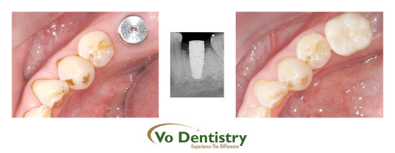 dental implant, collins hill, dacula, lawrenceville, ga, georgia