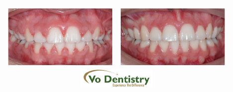 laser surgery, teeth lengthening, gum surgery, gingivectomy, dentists, cosmetic dentists,  implant dentists, family dentist, general 
dentist, restorative dentist, children dentist,  cosmetic dentistry, implant dentistry, laser dentistry, dentist Lawrenceville, Lawrenceville 
dentist, Gwinnett dentist, dentist Georgia, dentist Atlanta, Dr. Vo, Dr. Lia Vo, Vo Dentistry, female dentist, woman dentist, porcelain 
crowns, porcelain veneers, bridges, dental implants, extrac...