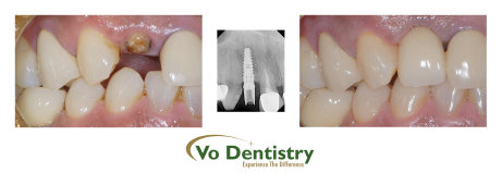 Dental Implant, Cosmetic Dentistry, Broken teeth, Missing Teeth, Lawrenceville, GA 30043