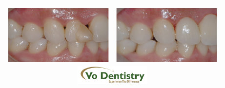 ceramic crown, no metal crown, tooth color crown, Vo Dentistry, Lawrenceville, GA 30043