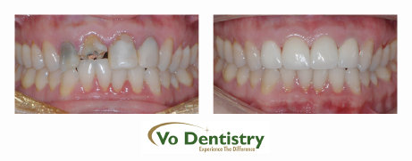 Tooth colored crowns, ceramic cowns, cosmetic crown, no metal crowns, dentists, cosmetic dentists,  implant dentists, family dentist, 
general dentist, restorative dentist, children dentist,  cosmetic dentistry, implant dentistry, laser dentistry, dentist Lawrenceville, 
Lawrenceville dentist, Gwinnett dentist, dentist Georgia, dentist Atlanta, Dr. Vo, Dr. Lia Vo, Vo Dentistry, female dentist, woman 
dentist, porcelain crowns, porcelain veneers, bridges, dental implant...