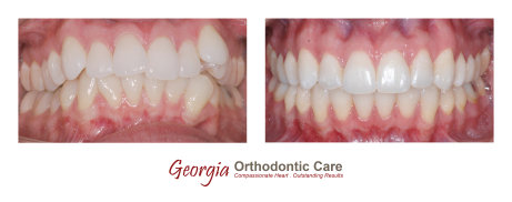 Orthodontic treatments, dentists, cosmetic dentists,  implant dentists, family dentist, general dentist, restorative dentist, children 
dentist,  cosmetic dentistry, implant dentistry, laser dentistry, dentist Lawrenceville, Lawrenceville dentist, Gwinnett dentist, 
dentist Georgia, dentist Atlanta, Dr. Vo, Dr. Lia Vo, Vo Dentistry, female dentist, woman dentist, porcelain crowns, porcelain veneers, 
bridges, dental implants, extractions, wisdom teeth removal, deep cle...