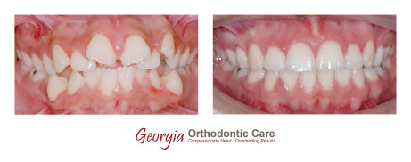 Orthodontic treatments, dentists, cosmetic dentists,  implant dentists, family dentist, general dentist, restorative dentist, children 
dentist,  cosmetic dentistry, implant dentistry, laser dentistry, dentist Lawrenceville, Lawrenceville dentist, Gwinnett dentist, 
dentist Georgia, dentist Atlanta, Dr. Vo, Dr. Lia Vo, Vo Dentistry, female dentist, woman dentist, porcelain crowns, porcelain veneers, 
bridges, dental implants, extractions, wisdom teeth removal, deep cle...