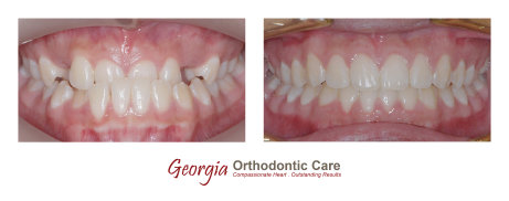 Orthodontic treatments, dentists, cosmetic dentists,  implant dentists, family dentist, general dentist, restorative dentist, children 
dentist,  cosmetic dentistry, implant dentistry, laser dentistry, dentist Lawrenceville, Lawrenceville dentist, Gwinnett dentist, 
dentist Georgia, dentist Atlanta, Dr. Vo, Dr. Lia Vo, Vo Dentistry, female dentist, woman dentist, porcelain crowns, porcelain veneers, 
bridges, dental implants, extractions, wisdom teeth removal, deep cle...