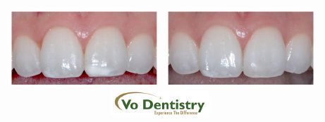 White Spots, Decalcification, Fluorosis Restoration, dentists, cosmetic dentists,  implant dentists, family dentist, general dentist, 
restorative dentist, children dentist,  cosmetic dentistry, implant dentistry, laser dentistry, dentist Lawrenceville, Lawrenceville 
dentist, Gwinnett dentist, dentist Georgia, dentist Atlanta, Dr. Vo, Dr. Lia Vo, Vo Dentistry, female dentist, woman dentist, porcelain 
crowns, porcelain veneers, bridges, dental implants, extractions, w...